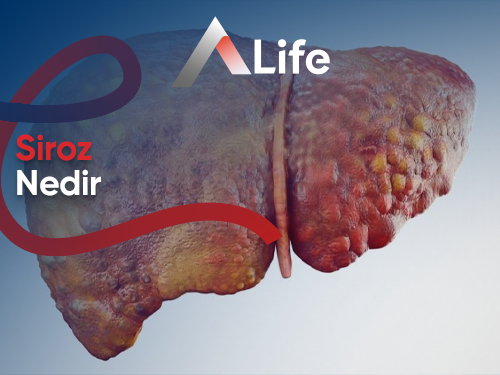 Siroz Nedir ?